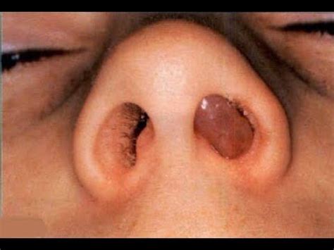 They connect with the nasal cavity. How to Cure Nasal Polyps Permanently and Naturally- Get ...