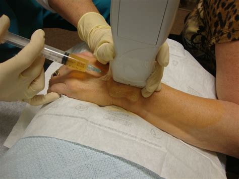 Triangular fibrocartilage complex (tfcc) injury. Ultrasound Guided PRP Injection Central TFCC