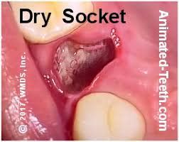I caught dry sockets when i had mine out. DRY SOCKET {ALVEOLAR OSTEITIS} - GLOBAL INDIAN NURSES ...
