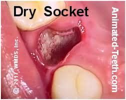 A history of having dry sockets. DRY SOCKET {ALVEOLAR OSTEITIS} - GLOBAL INDIAN NURSES ...