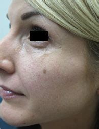 Roseville Facial Capillaries Treatment Before and After ...
