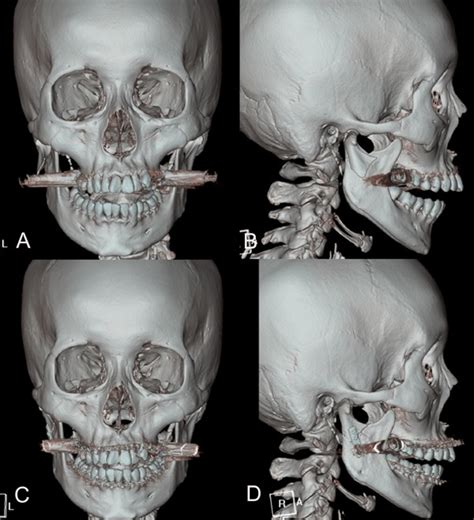 Clinical and radiological outcomes of transoral endoscope ...