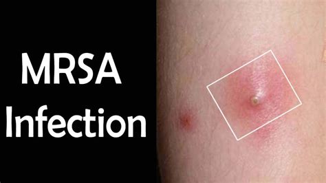 Mar 16, 2021 · mrsa is a type of staph bacteria that has become resistant to the effects of many common antibiotics. MRSA Infection - Symptoms, Causes and Methods to Cure MRSA ...