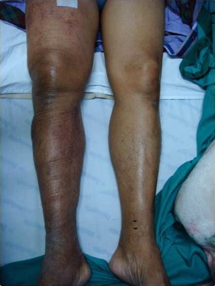 Trombosis vena dalam disebabkan oleh penyakit atau kondisi apa pun yang mencegah darah mengalir atau membeku secara normal. Spesialis Bedah Vaskular dan Endovaskular: Penyakit ...