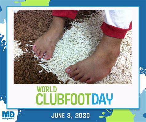 The 3rd of june is world clubfoot day, and this year, the steps charity used it to raise funds to purchase ppe for clinic caregivers. Pin on World Clubfoot Day 2020!