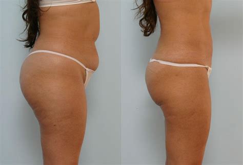 At iowa face + body, we offer nonsurgical body contouring to help patients achieve their ideal figures without all the time and discomfort associated with more invasive treatments. Lipo | Des Moines Iowa Plastic Surgery