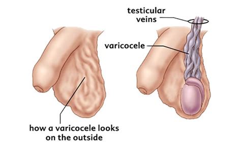 Nonsurgical treatment for male infertility caused by varicoceles. Varicocele