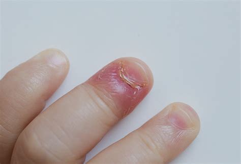 Frequent manicures and pedicures or the use of gel or acrylic nails can. Infection on a child's nail