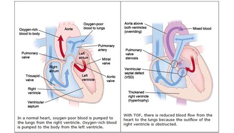 Kekurangan oksigen pada janin dapat terjadi pada setiap kehamilan. Tetralogy of Fallot; 4 Kelainan Jantung pada Bayi Baru ...
