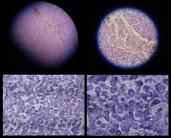 Because the symptoms are nonspecific, most patients are diagnosed with the disease at an advanced stage. What is Mesothelioma? - Definition, Symptoms & Causes ...