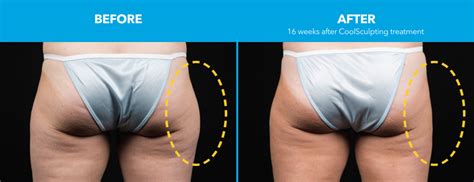 Whether it is leg hair removal or a simple upper lip treatment you will never regret not having to deal with costly waxing or painful tweezing. Des Moines CoolSculpting | Des Moines Iowa Plastic Surgery