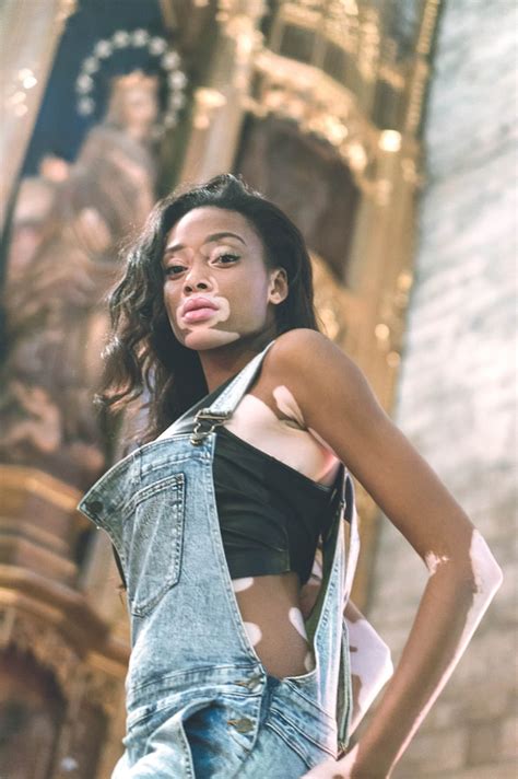 Elle est mannequin et atteinte d'une dépigmentation de peau appelée vitiligo,. Picture of Chantelle Brown-Young