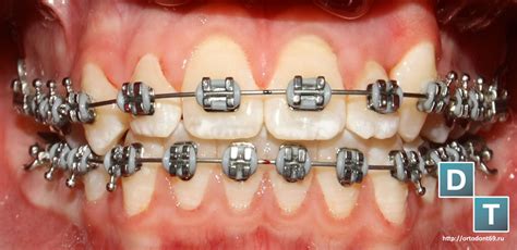 Картинки по запросу металлические брекеты Брекеты | Врач-ортодонт в Твери — Трезубов Алексей ...