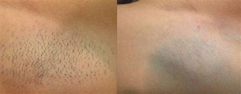 Brazilian hair removal is not painful. Before and after burn during laser hair removal | Laser ...