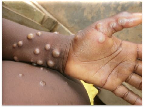 The orthopoxvirus genus also includes variola virus (the cause of smallpox), vaccinia virus (used in the smallpox vaccine), and cowpox virus. Monkeypox