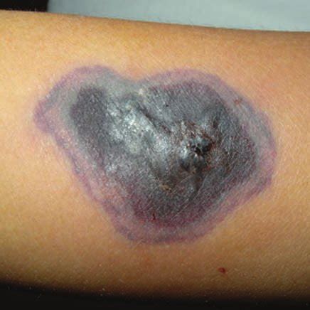 Savesave mucormicosis cutánea con rhizopus microsporus for later. Cultivo en agar dextrosa de Sabouraud que desarolló ...