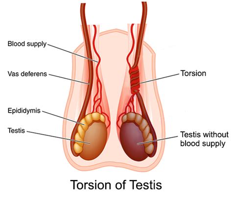 Ductus deferens, pampiniform plexus, lymphatic vessels. Male Infertinity Due To Testicular Torsion | Vinn Hospital