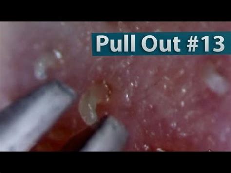 Read on to find treatments and tips for good skin care. #13 Pull Out Blackheads Close up - Blackheads Removal ...