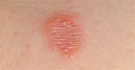 There are two main categories of skin lesions: Skin lesions: Pictures, treatments, and causes