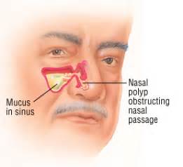 Nasal polyps usually grow in the shape of a teardrop. Do I need surgery to remove a nasal polyp? - Ask Doctor K ...