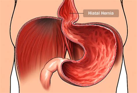 Most hernias happen within the abdominal cavity, between the in women, the inguinal canal contains the round ligament that gives support for the womb. General Surgery - Specialty Surgical Associates