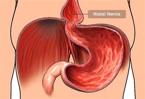 You see, inguinal hernias are quite rare in females, with only about a 3% lifetime risk. How to Spot a Hernia ( courtecy;- webMD ) CLICK TWICE TO APEADER SLIDING )
