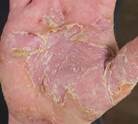 Skin irritation and inflammation of the hand is called hand eczema or hand dermatitis. The chinese medicine treatment of hand eczema - Drishti ...