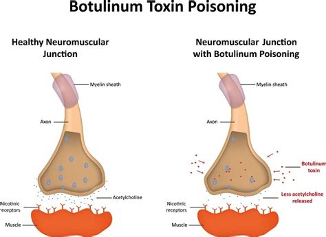 Botulisme adalah penyakit langka dan serius yang disebabkan oleh racun saraf (neurotoksin) yang dihasilkan oleh bakteri clostridium botulinum. Botulisme - patofisiologi, diagnosis, penatalaksanaan ...