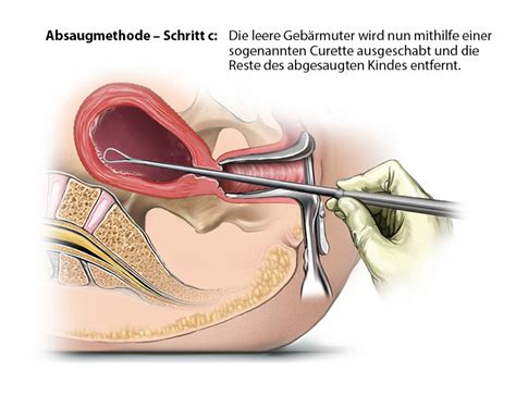 Wer sich für einen schwangerschaftsabbruch (umgangssprachlich „abtreibung) entscheidet, muss gesetzliche regelungen und fristen einhalten. Bis wann abtreibung moglich. Bis zur wievielten ssw ...