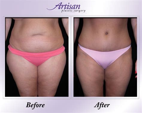 For over 72 years, mariani & richards, inc. Tummy Tuck Pittsburgh - Abdominoplasty Greensburg, PA