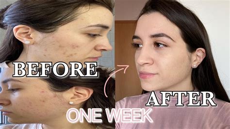 Newborn acne tends to manifest itself as small whiteheads that appear on the chin, forehead, and sometimes on the back. HOW TO GET RID OF ACNE / ACNE SCARING FAST! | DRUGSTORE ...