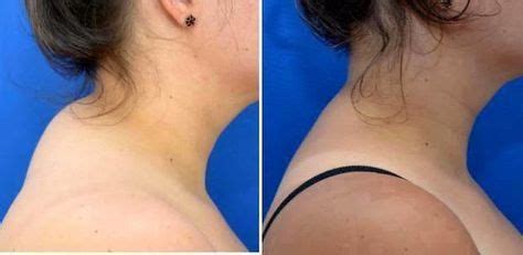 Some people tend to accumulate fat on the back of the neck. Buffalo Hump Removal | Buffalo hump, Neck hump, Neck exercises
