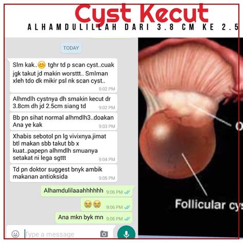 Malah biasanya ia tak disedari pun melainkan memang kalau ada buat medical checkup (scan dan sebagainya). Cara Berkesan Rawat dan Kecutkan Cyst Dengan Selamat ...