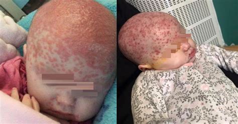 In newborn babies the sweat glands can be overactive and release an oily sebum that. Six-month-old baby infected with herpes disease from a ...
