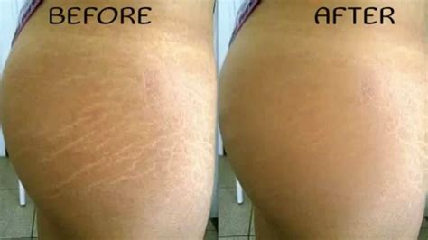 Hi my name is laurie. How to Get Rid of Stretch Marks: 5 Effective Home Remedies