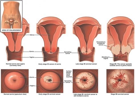 Selalunya walaupun seseorang pesakit mengalami sembelit, mereka masih boleh kentut. Tanda-Tanda Mengesan Kanser Pangkal Rahim. Semua Wanita ...