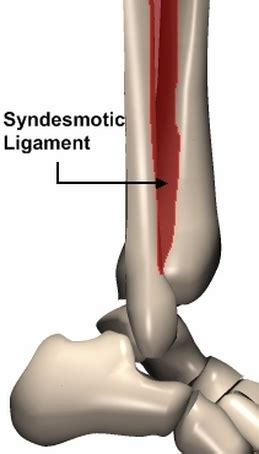 Also known as a high ankle sprain. High Ankle Sprain - Ankle Special Tests