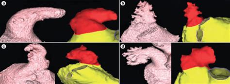 Cacti and succulents is a misnomer. Image showing LAA morphology types. (a) Chickenwing; (b ...