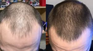 Response to microneedling treatment in men with androgenetic alopecia who failed to respond to a randomized evaluator blinded study of effect of microneedling in androgenetic alopecia: finasteride, minoxidil & microneedling | WRassman,M.D ...