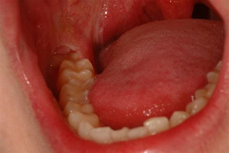 Don't expect the face to look completely normal within. Pericoronitis - Pictures, Treatment, Symptoms, Causes ...