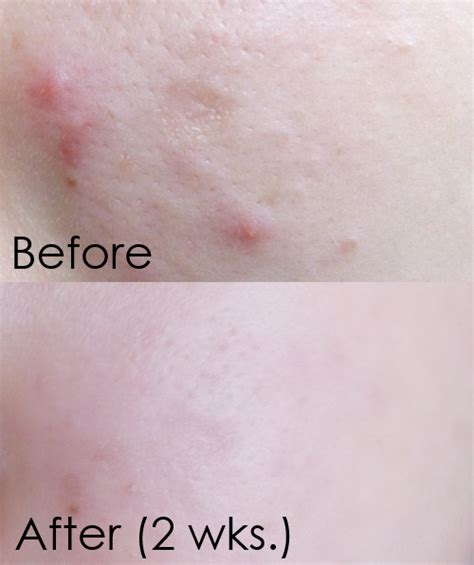 However, it's generally more likely to fade than true acne scars because the tissue underneath isn't damaged. How Long Does It Take For Acne Scars To Fade