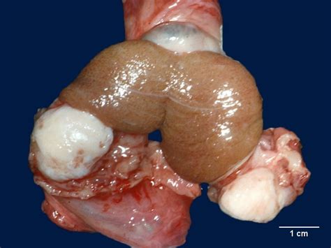 ♦ congestive heart failure can cause lymphatic obstructions in the body by way of compromised blood flow. Webpathology.com: A Collection of Surgical Pathology Images