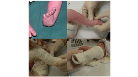 From this series of patients treated with comprehensive clubfoot release. a Clubfoot deformity with adduction, equines, and ...