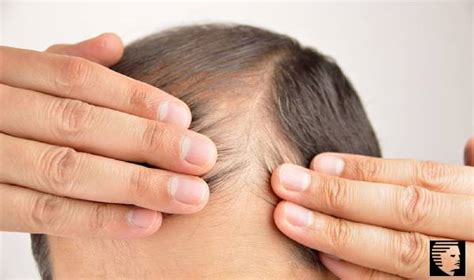 However, in men, the change in hair density is easily visible. 6 Prominent Causes of Hair Loss in Men - AHS India