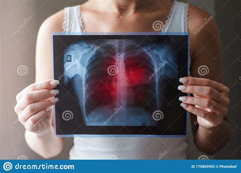 Preconditioning rat with three lipid emulsions prior to acute lung injury affects cytokine production and cell apoptosis in the lung and liver. Lung Radiography Concept. Virus And Bacteria Infected The ...