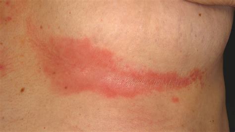 Intertrigo (intertriginous dermatitis) is an inflammatory condition of skin folds, induced or aggravated by heat, moisture, maceration, friction. Intertrigo - Symptoms Causes And Treatment Of Intertrigo ...