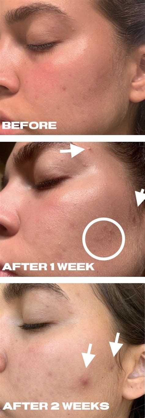 Skin doesn't absorb nutrients or vitamins / minerals. REVIEW Klairs Freshly Juiced Vitamin E Mask (Before and ...