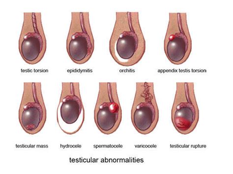 You may feel a soft tube at the back of each testicle, which is called the epididymis. What is Testicular Cancer? | Health Life Media