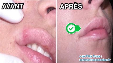 L'herpès labial, aussi appelé « bouton de fièvre », est une infection des lèvres qui affecte des millions de personnes par an. Comment Faire Disparaître un Bouton de Fièvre Avec du ...