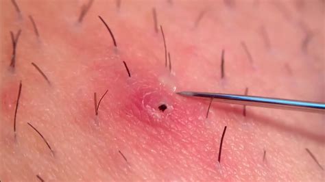 As with other forms of hair removal, use a body scrub or ingrown hair treatment once the skin has settled if you're worried about irritating ingrown hairs. Crazy Ingrown Hair Removal part 1 - YouTube